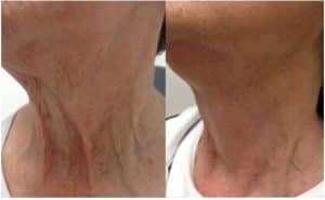 Before and After Skin Rejuvenation treatment
