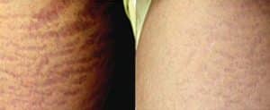 stretchmarks and skin rejuvenation treatments