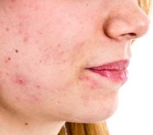 Outbreak of Acne