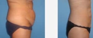 Before and After Liposuction Treatment