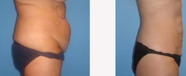 Tummy Tuck - Before and After