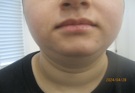 before necktite liposuction - front