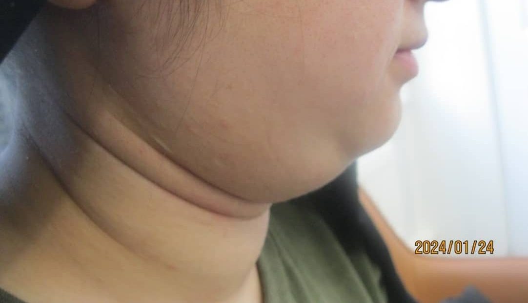 3 - before necktite liposuction - side 2 before necktite liposuction - side 2