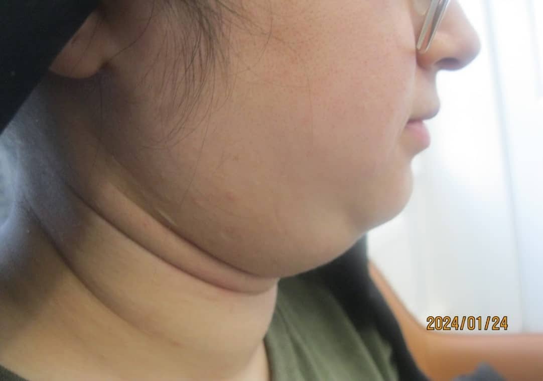 before necktite liposuction - side 2