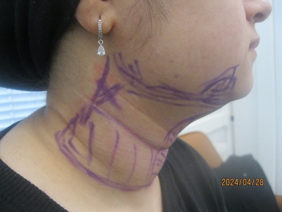 3 - necktite liposuction procedure - side