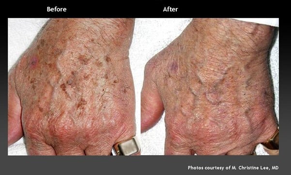 Intense pulsed light for ageing hands
