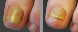 Laser Fungal Nail Infection Removal