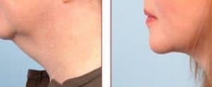 NeckTite Liposuction and Tightening