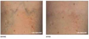 Reticular Veins - Before and After