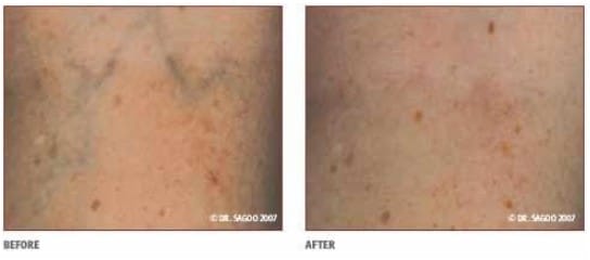 Before and After Thread Vein Knees