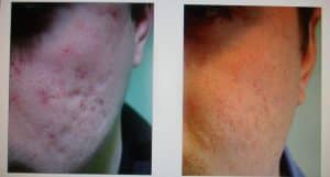 Before & After Treatment for Acne Scarring