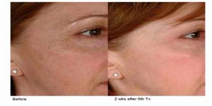 Before & After Laser Pigmentation Removal Treatment