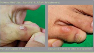Before & After Little Toe Laser Wart Removal Treatment