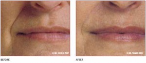Injectable Filler Treatment Around the Lips