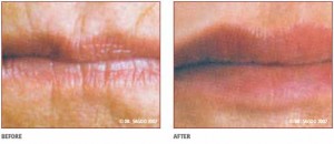 Before & After Lip Treatment Using Injectable Fillers