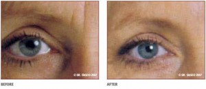 Before & After Injectable Filler Treatment for Eye Wrinkls