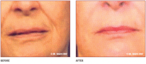 Before & After Injectable Lip Filler Treatment