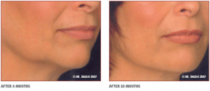 Before & After Injectable Filler Treatment for Chin
