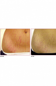 Before & After Medical Microdermabrasion For Stretch Marks