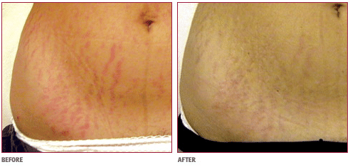 Medical Microdermabrasion For Stretch Marks