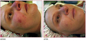 Face Treatment Using Medical Microdermabrasion