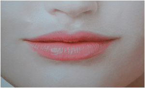 Lip Treatments at Solihull Medical Cosmetic Clinic
