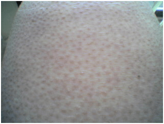 Keratosis Pilaris on Leg