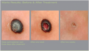 Stages of Laser Wart Removal