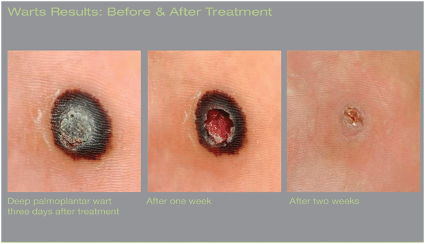 Before and After Wart Removal Treatment