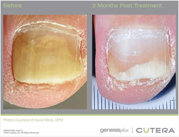 Genesis Treatment - Before and After