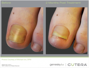 Before & After Fungal Nail Treatment