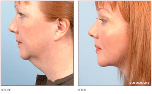 Before and After Neck Tightening