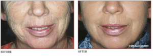 Before & After Fractional CO2 Laser Treatment