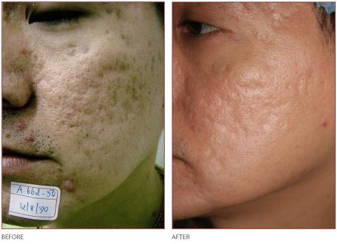 CO2 Resurfacing Laser: Before, During, After