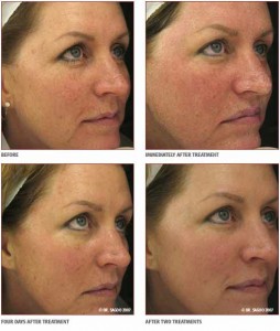 Before & 2 Treatments After Results From Laser Pigmentation