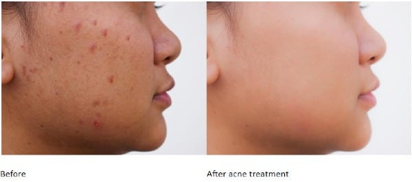Before and After Acne Treatment