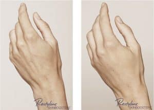 ageing hands treatment
