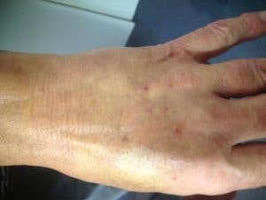 After Injectiosn for Ageing Hands