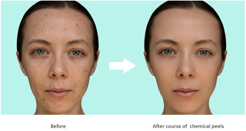 Before and After Chemical Peels