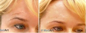 Scar Reduction Treatment Before & After Results