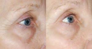 Before and After Eye Peel