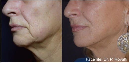 Before and After Facetite Treatment