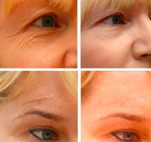 Before & After Wrinkle Reduction