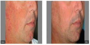 Facial Veins - Before and After