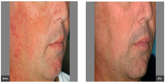 Before and After Thread Veins in Face