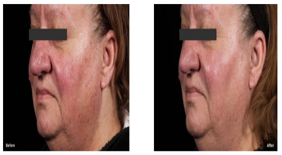 Before and After Thread Veins in Face