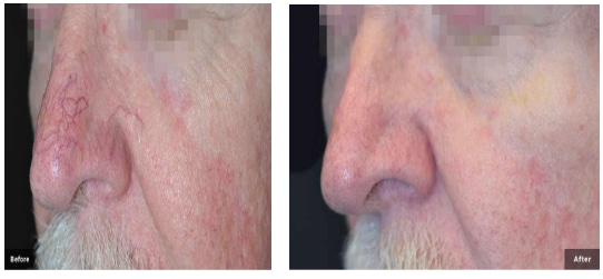 Before and After Thread Veins in Nose