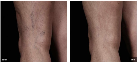 Before and After Thread Veins Behind Knee