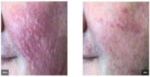 Facial Veins - Before and After