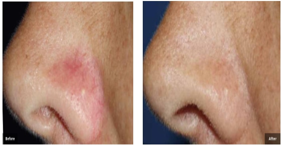 Before and After Thread Veins in Nose